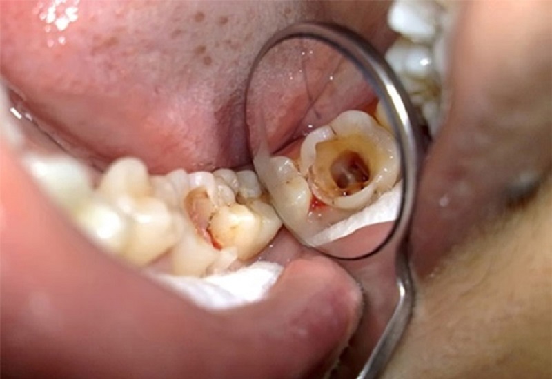 Răng khôn bị sâu vỡ rất dễ dẫn đến các biến chứng nghiêm trọng khác
