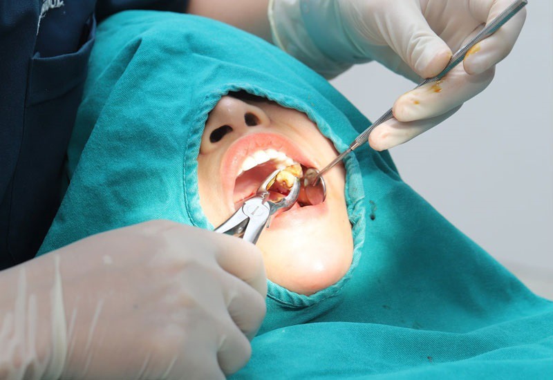 Nhổ răng là biện pháp hiệu quả để ngăn ngừa các biến chứng về sau