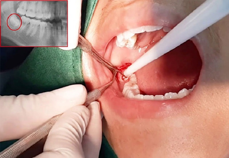 Hình ảnh bác sĩ đang tiến hành nhổ răng số 8 bị sâu vỡ cho bệnh nhân