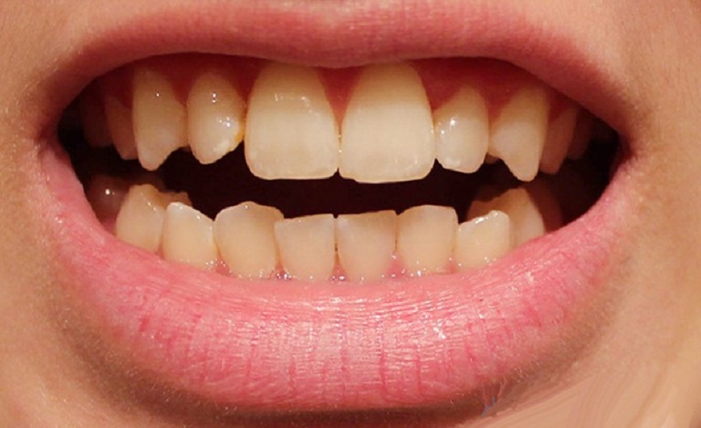 Trường hợp vệ sinh không đúng cách khiến răng bị ố vàng