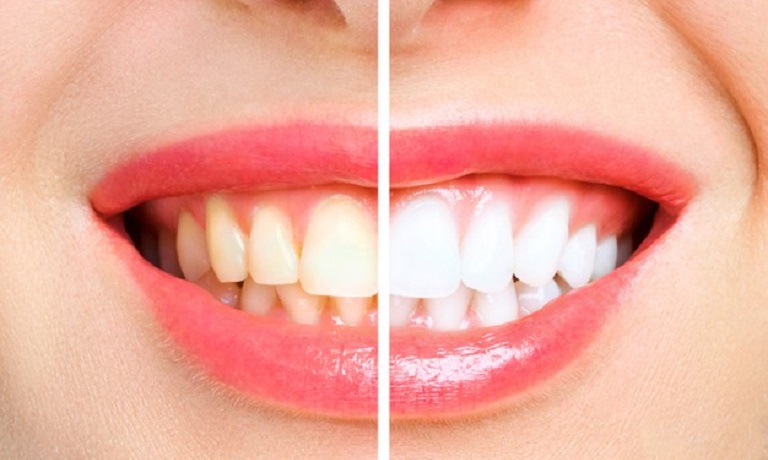 Trước và sau khi tẩy trắng răng