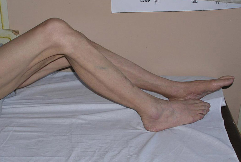 Teo cơ chân khiến khả năng vận động của người bệnh bị suy giảm nghiêm trọng