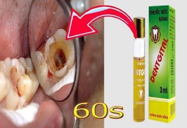 Thuốc chữa đau răng Dentgital được dùng để bôi trực tiếp tại vị trí răng, lợi bị tổn thương