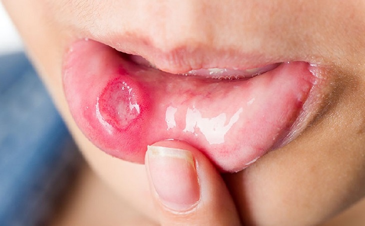 Thuốc có khả năng điều trị hiệu quả các bệnh lý về răng miệng