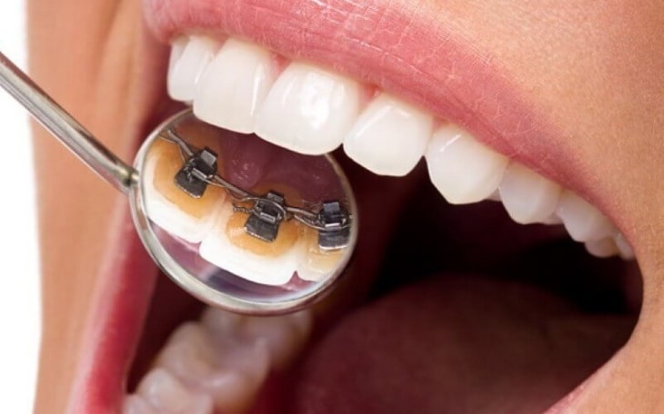 Phương pháp niềng răng mắc cài mặt trong có giá thành khá cao