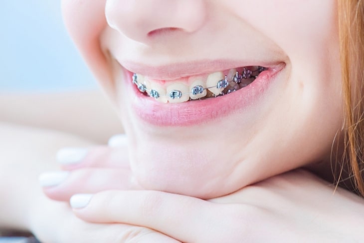 Nếu bỏ lỡ thời điểm "vàng" để niềng răng thì vẫn có thể thực hiện trong giai đoạn 17 - 25 tuổi