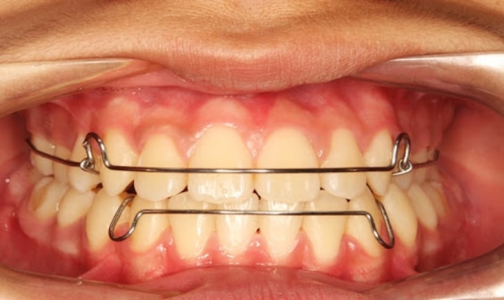 Niềng răng bằng khí cụ tháo lắp phù hợp với trẻ có tình trạng răng đơn giản