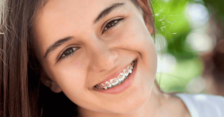 Chi phí niềng răng bằng phương pháp mắc cài kim loại phù hợp với đa số mọi người