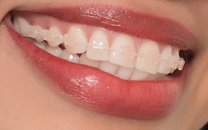 Niềng răng bằng mắc cài có chất liệu sứ hoặc pha lê thân thiện với khoang miệng