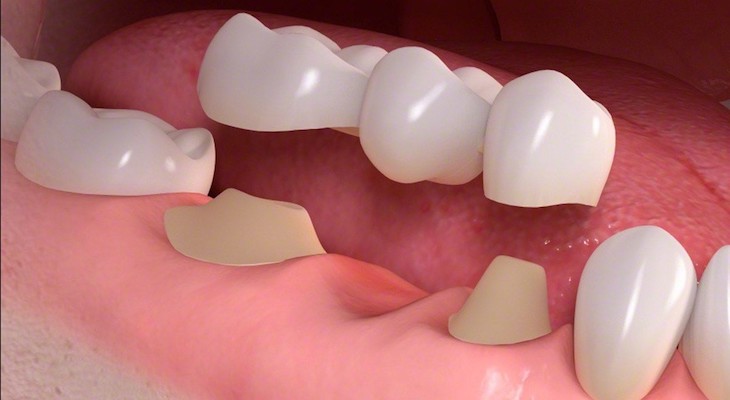 Cầu răng sứ mang đến một hàm răng đạt thẩm mỹ tốt, bền chắc với thời gian 