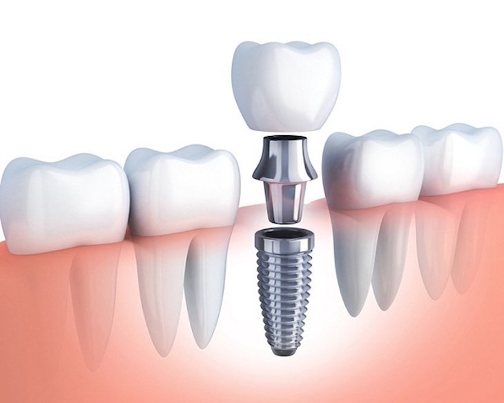 Cấy ghép implant mang đến hiệu quả và chức năng ăn nhai gần như răng thật 
