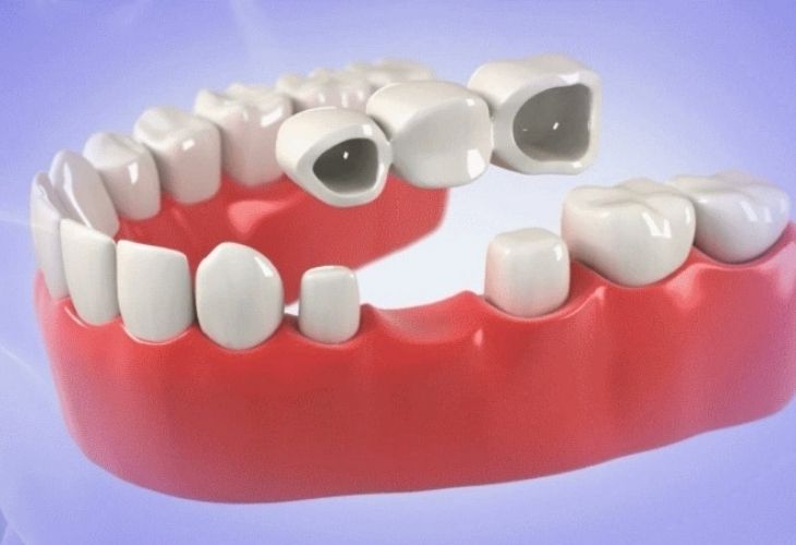 Trồng răng giả vĩnh viễn bằng bắc cầu răng sứ là phương pháp được nhiều người lựa chọn