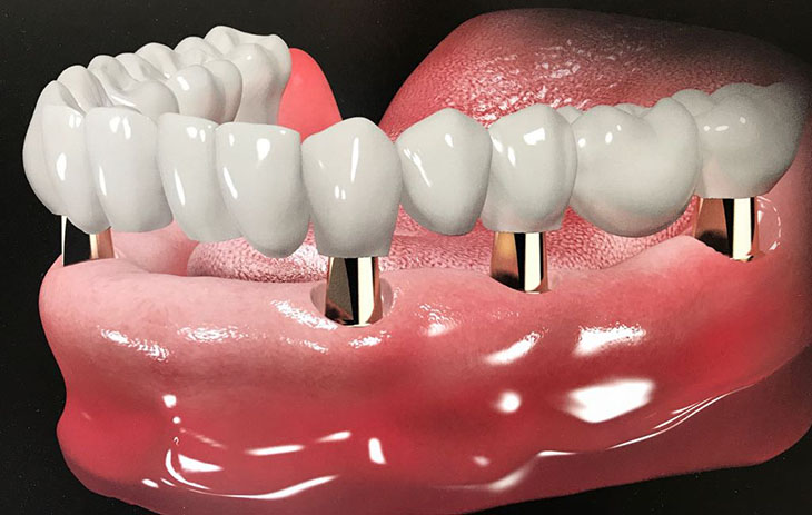 Trồng răng hàm giá bao nhiêu phụ thuộc vào nhiều yếu tố khác nhau
