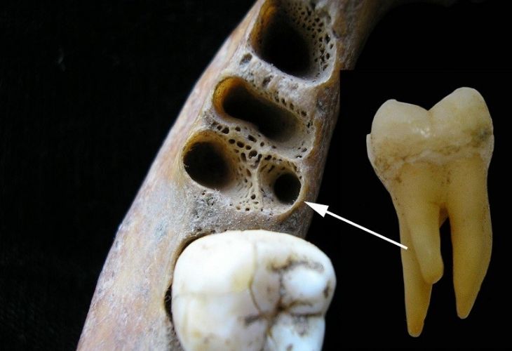 Răng hàm thường sẽ có 3 - 4 chân răng