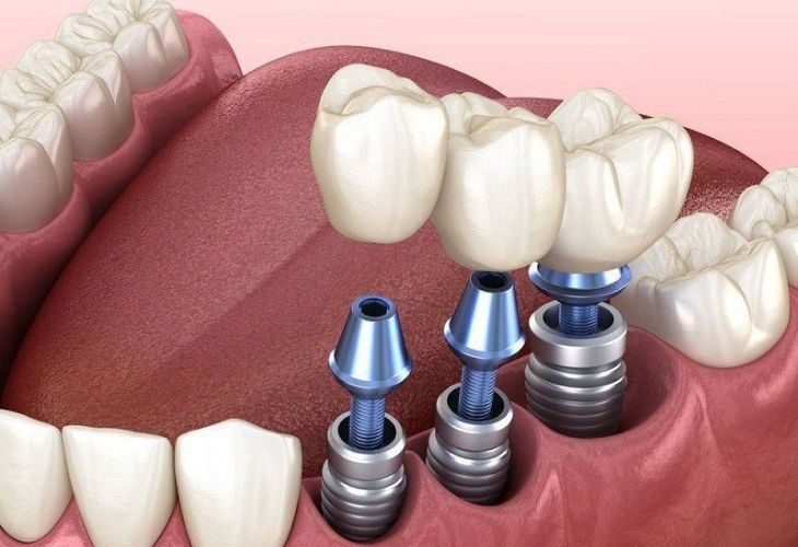 Trồng răng hàm sẽ ít đau hơn nếu được thực hiện tại nha khoa uy tín với đầy đủ thiết bị nha khoa hiện đại