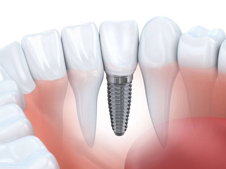 Nhiều người quan tâm về dịch vụ trồng răng Implant giá rẻ tại TPHCM