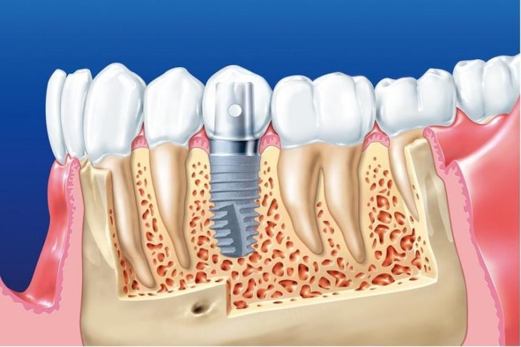 Trồng răng Implant trả góp giúp khách hàng giảm bớt áp lực kinh tế