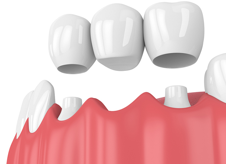 Trồng răng nanh bao nhiêu tiền bằng cầu răng sứ - Khoảng 1-8 triệu/răng