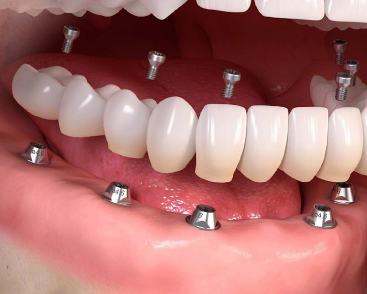 Trồng răng giả nguyên hàm giá bao nhiêu phụ thuộc vào từng phương pháp