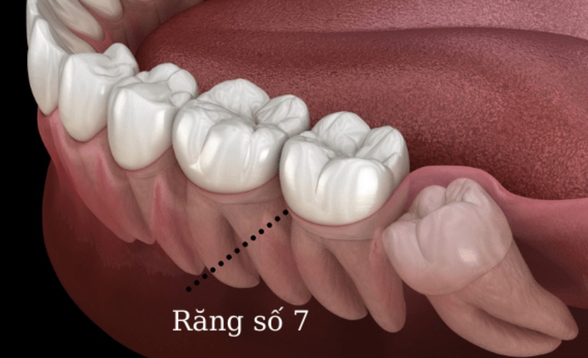 Răng số 7 nằm cạnh răng khôn và có vai trò quan trọng đối với hàm