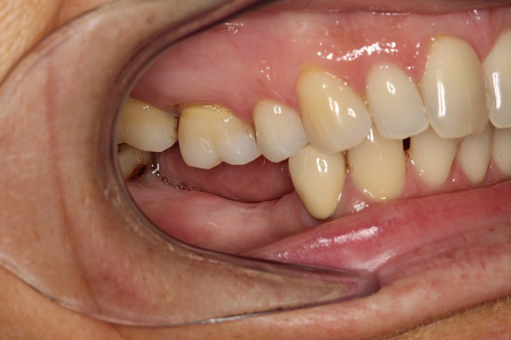 Mất răng số 7 có thể gây ra nhiều hậu quả nghiêm trọng với sức khỏe
