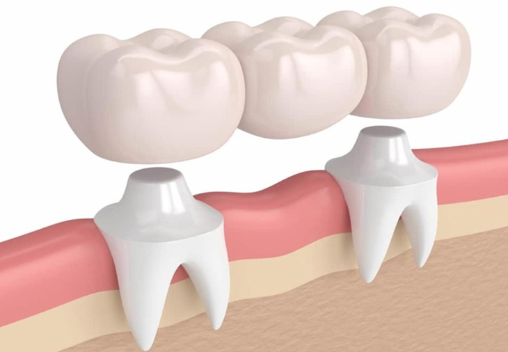 Làm cầu răng sứ là một phương pháp được dùng trong trồng răng số 7