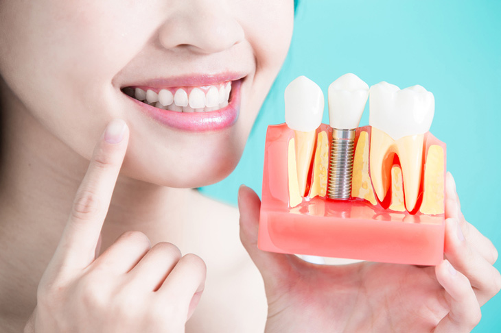 Cấy ghép Implant được ưu tiên sử dụng khi cần trồng răng số 7