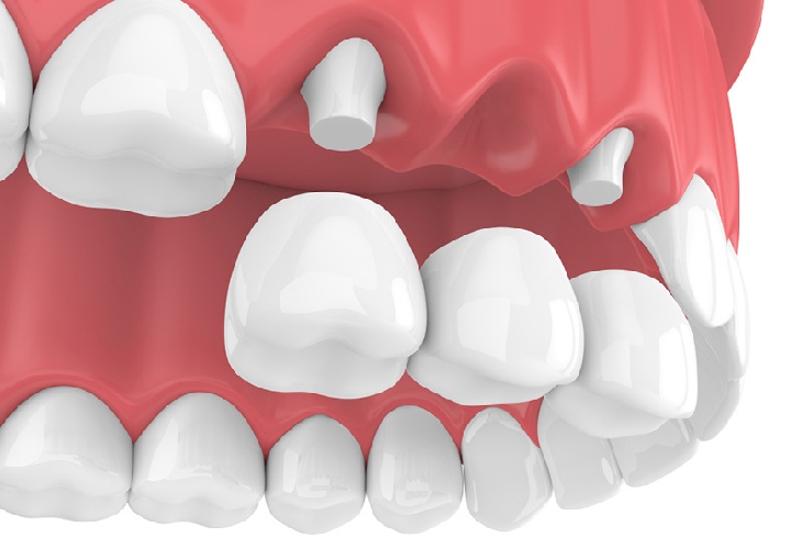 Cầu răng sứ là lựa chọn cho khách hàng có chân răng chắc khỏe