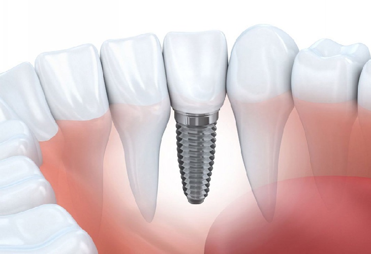Phương pháp cấy ghép implant khôi phục hoàn toàn chiếc răng đã mất