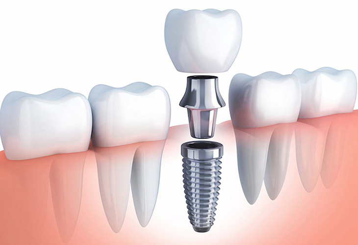 Trồng răng sứ titan giá bao nhiêu phụ thuộc vào phương pháp thực hiện