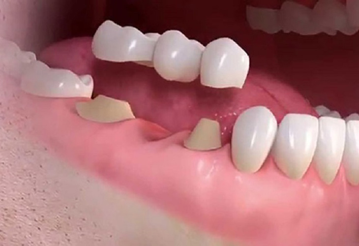 Cầu răng sứ có chi phí trồng răng thấp hơn implant